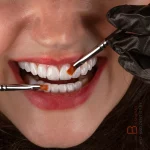 نمونه کار کامپوزیت انجام شده در کلینیک دکتر بشارت