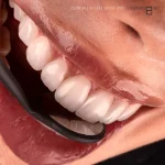 نمونه کار کامپوزیت انجام شده توسط دکتر بهروز بشارت