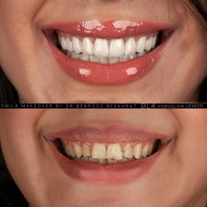 نمونه کار لمینت انجام شده توسط دکتر بهروز بشارت