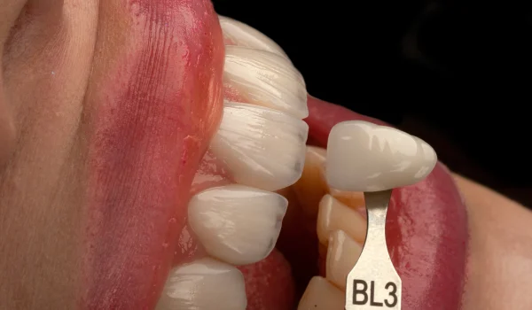 تفاوت های کامپوزیت و لمینت دندان