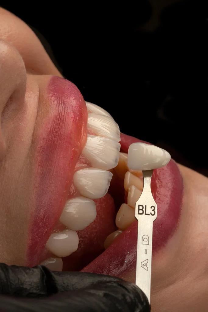 تفاوت های کامپوزیت و لمینت دندان