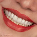 لمینت سرامیکی انجام شده توسط دکتر بهروز بشارت