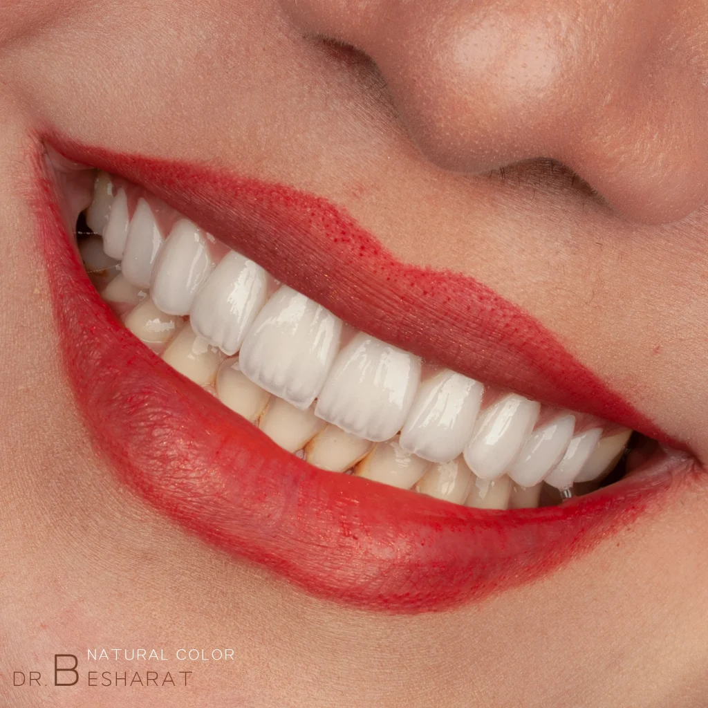 لمینت دندان فک بالا انجام شده توسط دکتر بشارت