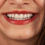 ماندگاری لمینت دندان چقدر است؟