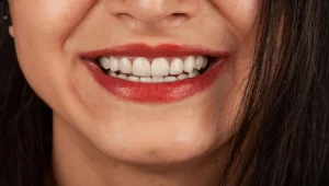 ماندگاری لمینت دندان چقدر است؟