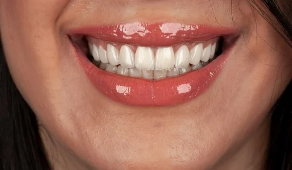 قیمت لمینت دندان در پاسداران در سال 1404