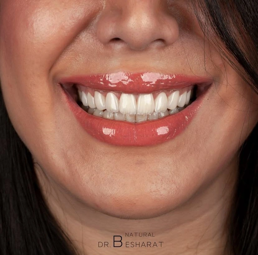 قیمت لمینت دندان در پاسداران در سال 1404